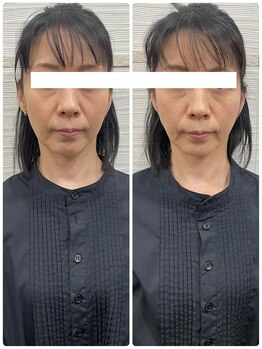 長寿鍼灸院 長寿整骨院/美容鍼25本の効果★小顔効果