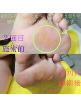 ドクターネイル爪革命 長野店/【たこ・うおのめ】リラク/足裏