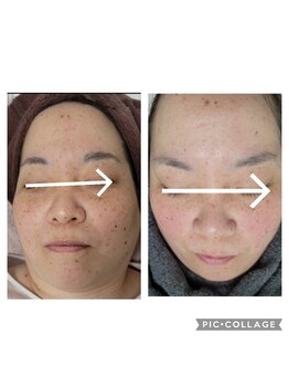 エスボーテ(sbeaute)/プラズマ+シミケア+水素パック