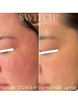 スイッチ(SWITCH!)/赤ら顔もプロセルセラピーズ！