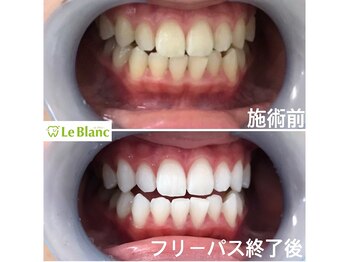 ルブラン 奈良店(Le Blanc)/白くしたい方は