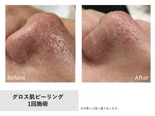 サロン ド ユイ(salon de yui)の雰囲気（毛穴でお悩みのお客様は多いです！）
