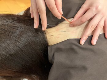 くるみの森鍼灸院の写真/【首肩コリ・頭痛に】深層マッサージ×鍼灸の相乗効果★国家資格者の手技で蓄積した疲れを根本から解消♪
