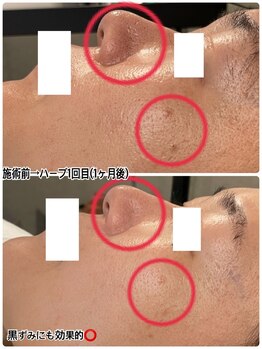 ハーシークレット(Her secret)/ハーブピーリング効果・黒ずみ