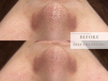 レヴィア(Revia)/毛穴ディープクレンジング