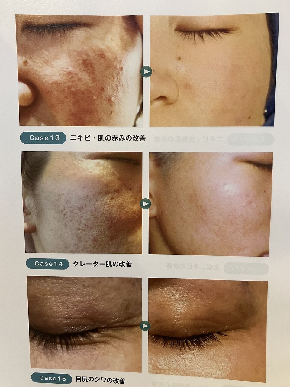 【年齢肌の救世主！あらゆるトラブルに◎】エステダーマ＋高濃度幹細胞\5980