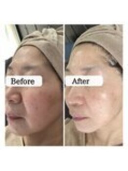 ル ボヌール 伊那店(le bonheur)/シミケア　4回目