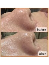 エステ ココ 土気店(Esthe CoCo)/#毛穴#毛穴洗浄