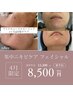 【ニキビケア】肌荒れの原因を徹底ケア!トラブルのない美肌へ/60分