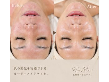 リミープラス 豊中曽根店(Re:Me+)の写真/卵肌叶えませんか？【剥離なし】敏感肌にも◎乳酸菌ピーリング☆メンズも◎