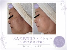 レゾン 京橋店の雰囲気（《ビフォーアフター》40代以上のスタッフが担当。大人の肌管理♪）