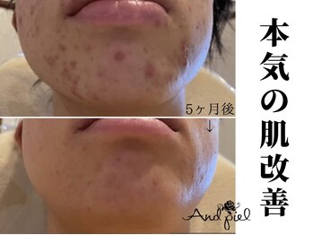 アンドピエル(AndPiel)/ニキビケアはお任せください♪