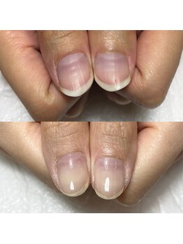 セラキュアネイル(Theracure nail)/自爪育成方法は？