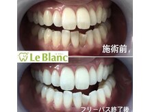 ルブラン 奈良店(Le Blanc)/本来の歯の白さへ！