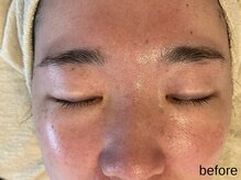 サロン ド エメ(salon de aimer)/【Before】赤み、毛穴に♪