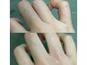 【人気★脱毛手足セット♪】手の指+足の指・甲 