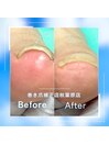 【巻き爪/陥入爪補正】