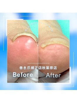 巻き爪補正店 秋葉原店/【巻き爪/陥入爪補正】