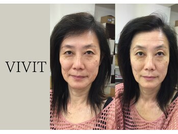 ビビット 久宝寺店(VIVIT)/リフトアップ/フェイシャル/小顔