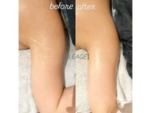 グレアージュ(GLEAGE)/全身痩身凹凸脂肪コース！