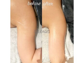 グレアージュ(GLEAGE)/全身痩身凹凸脂肪コース!