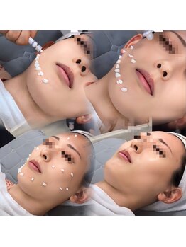 スア(SUA)/スピキュールトックス施術風景