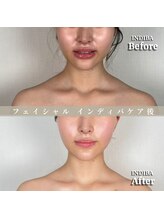 術後の女神 大阪心斎橋店/術後ケアインディバ・インディバ