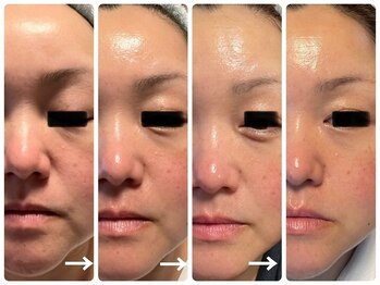 ヴィセラ(Vicella)/ラミピール1ヶ月チャレンジ!