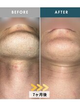 モモナ(Momona)/佐世保/脱毛/髭脱毛/全身脱毛