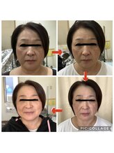 かず整骨院/光療法でしみ・赤み・たるみ改善