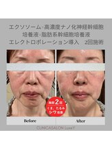 リュクシー(LuxeY)/高濃度ナノ幹細胞でたるみ改善