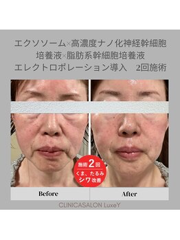 リュクシー(LuxeY)/高濃度ナノ幹細胞でたるみ改善