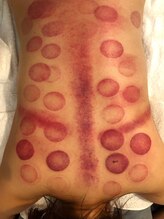 中国整体 らくらく堂/温熱療法吸い玉経絡マッサージ