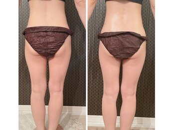 フォレドール(Foret D'or)/ハイパーナイフ1回