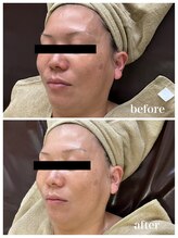 ジャスミン(Jasmin)/高濃度臍帯血幹細胞×NMN×AC-11