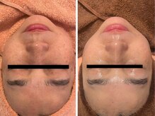 エムフルール(M fleur)/毛穴洗浄&美肌プレミアムコース