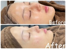 エレ(ele)/内部補修◎乳酸菌ピーリング