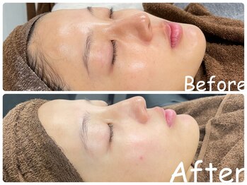 エレ(ele)/内部補修◎乳酸菌ピーリング