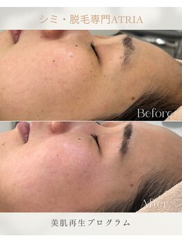 アトリア(ATRIA)/肌質改善プログラム