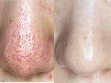 ミント/魅せる毛穴◎長年の悩み◎