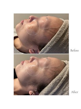 フイユ(feuille)/集中フェイシャルモニター様