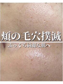 ミーラブ 鹿児島(miilove)の写真/黒ずみ・詰まり・角栓、とにかく毛穴を綺麗にしたい！そんなあなたにぴったりな毛穴レス肌になれるエステ。