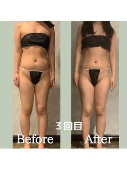 リンガ(Ringa)/ビフォーアフター　【腸活ケア】