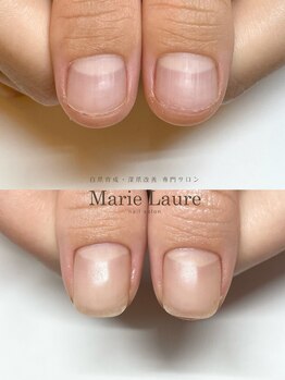 マリーロール 梅田店(Marie Laure)/自爪育成/深爪矯正/ネイルケア