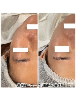 ハーシークレット(Her secret)/ハーブピーリング効果・くすみ