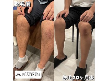 プラチナムニイガタ 新潟(PLATINUM NIIGATA)/足脱毛Before→after!