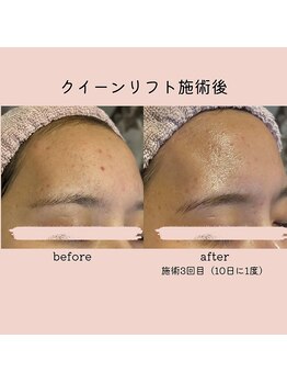 リリー(LILY)/クイーンリフトの効果