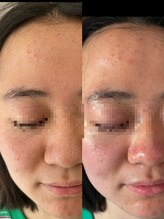 ビューティーザイオン(Beauty zion)/毛穴エクストラクション