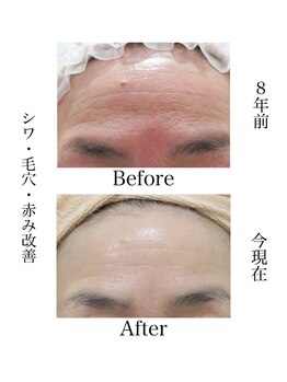 スマートポッシュ(Smart posh)/【シミケア】before→after