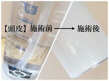 ヌー 栄(nuu)/ハイドラフェイシャル(頭皮）